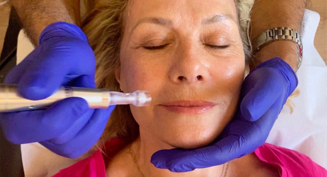 Micro-Needling Procedure On Glynis