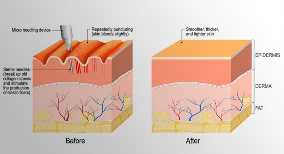 Microneedling