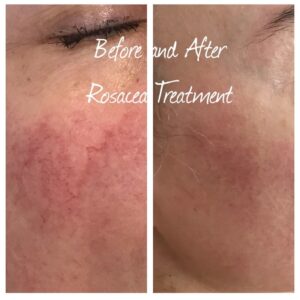 Rosacea Treatment Before/After