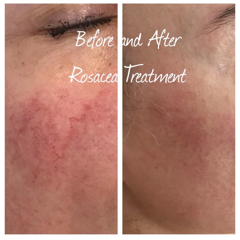 Rosacea Treatment Before/After